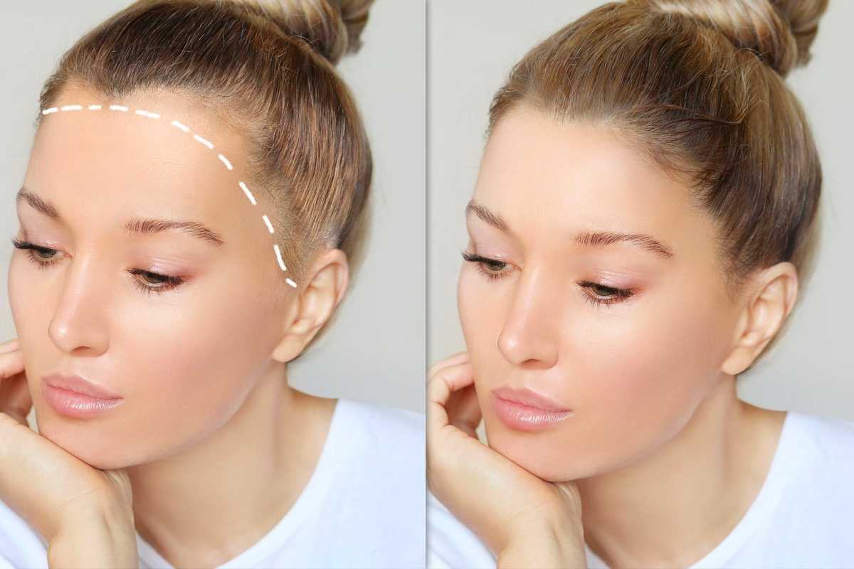 female-hair-transplant