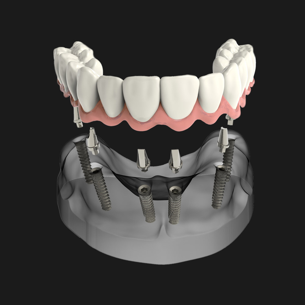 https://www.euroesthetic.net/wp-content/uploads/2025/01/implant-tedavisi-3d.jpg